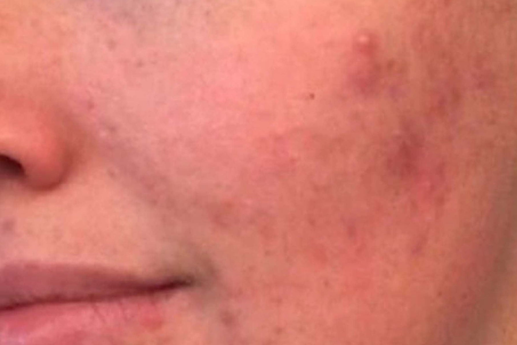 Close-up of a person's face with visible skin conditions