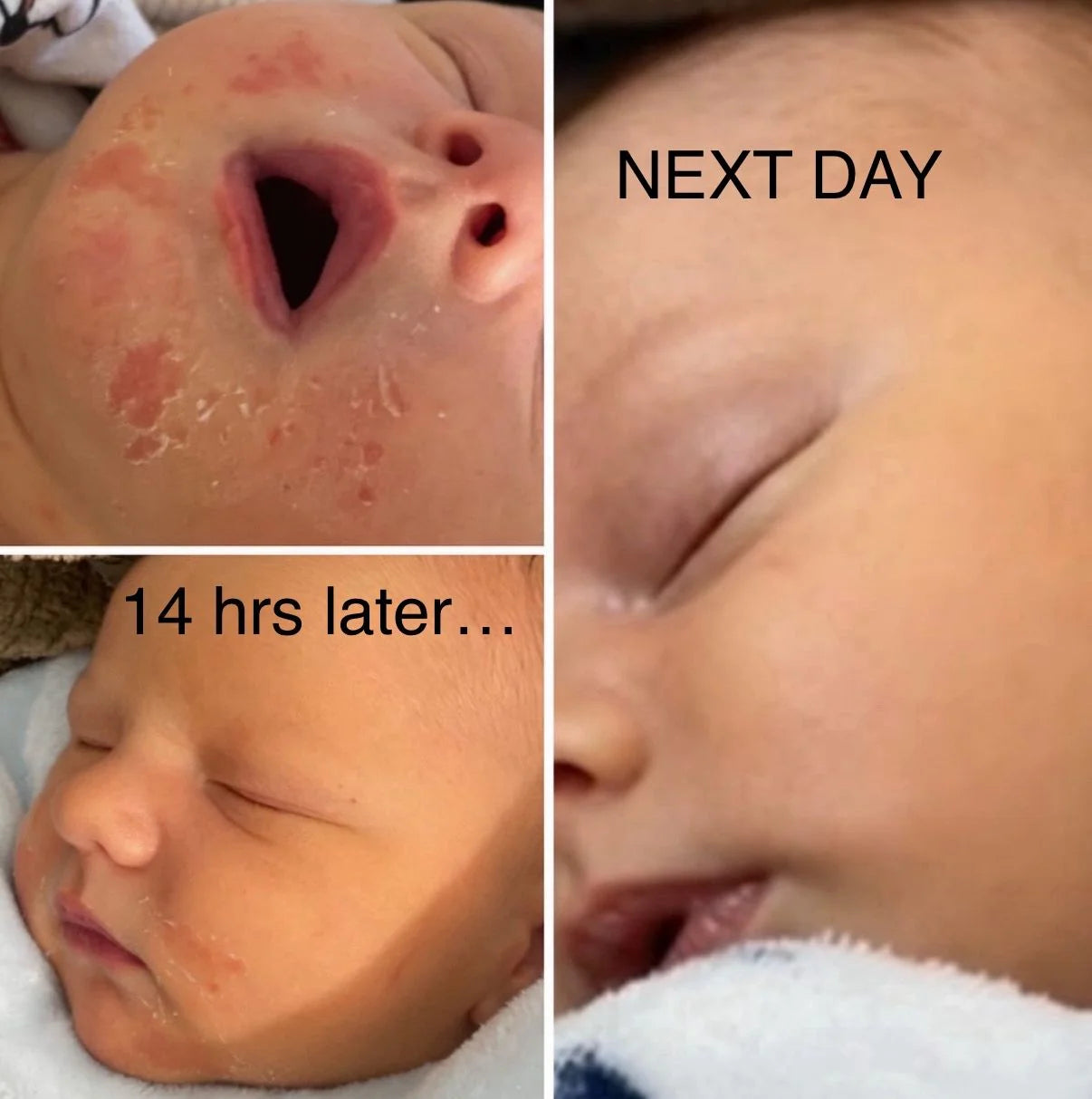 Nourish-d "HEAL-D" – Soothing Cream for Eczema and Psoriasis Relief