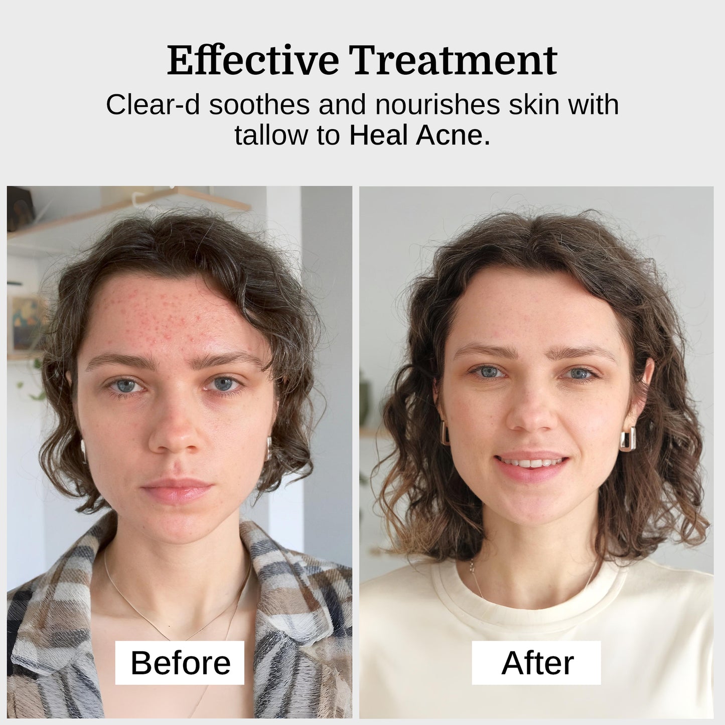 Nourish-d "CLEAR-D" – Clarifying Skincare for Acne-Prone Skin