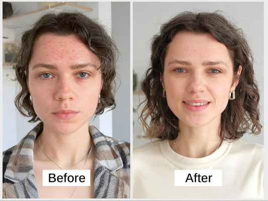 Nourish-d "CLEAR-D" – Clarifying Skincare for Acne-Prone Skin